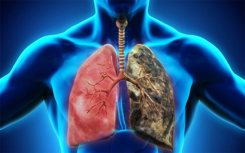 Bệnh ung thư phổi và những lầm tưởng phổ biến