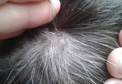 5 Nguyên nhân khiến bạn bị bệnh tóc bạc sớm