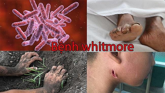 Theo Bộ Y tế, bệnh Whitmore (tên gọi khác là Melioidosis ) là một bệnh nhiễm trùng ở người và động vật do vi khuẩn Burkholderia Pseudomallei gây ra.