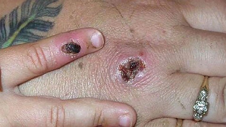 Da của người mắc bệnh sẽ hình thành sẹo do tổn thương - Ảnh: CNN