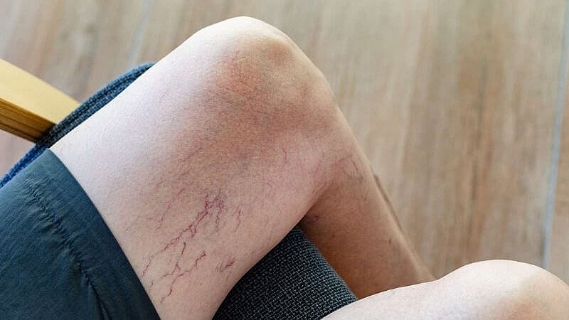 Hiểu rõ về căn bệnh suy giảm tĩnh mạch